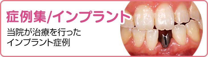 症例集/インプラント　当院が治療を行ったインプラント症例